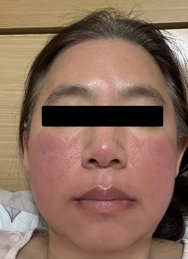 廣泛性接觸性皮炎急性期素顏照，兩頰、鼻翼、嘴角大面積泛紅